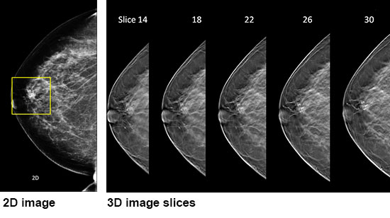 2D vs 3D Mammogram